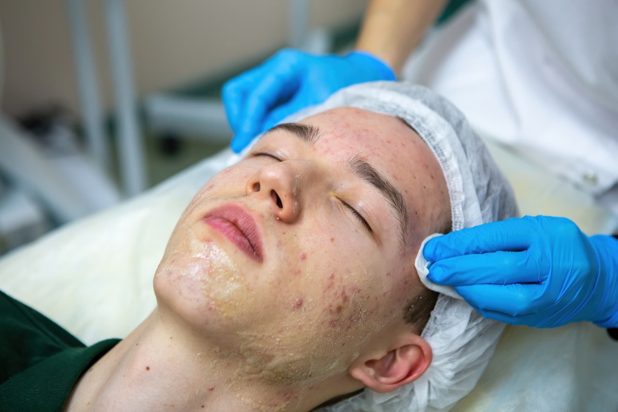 Dermatologia, l’acne