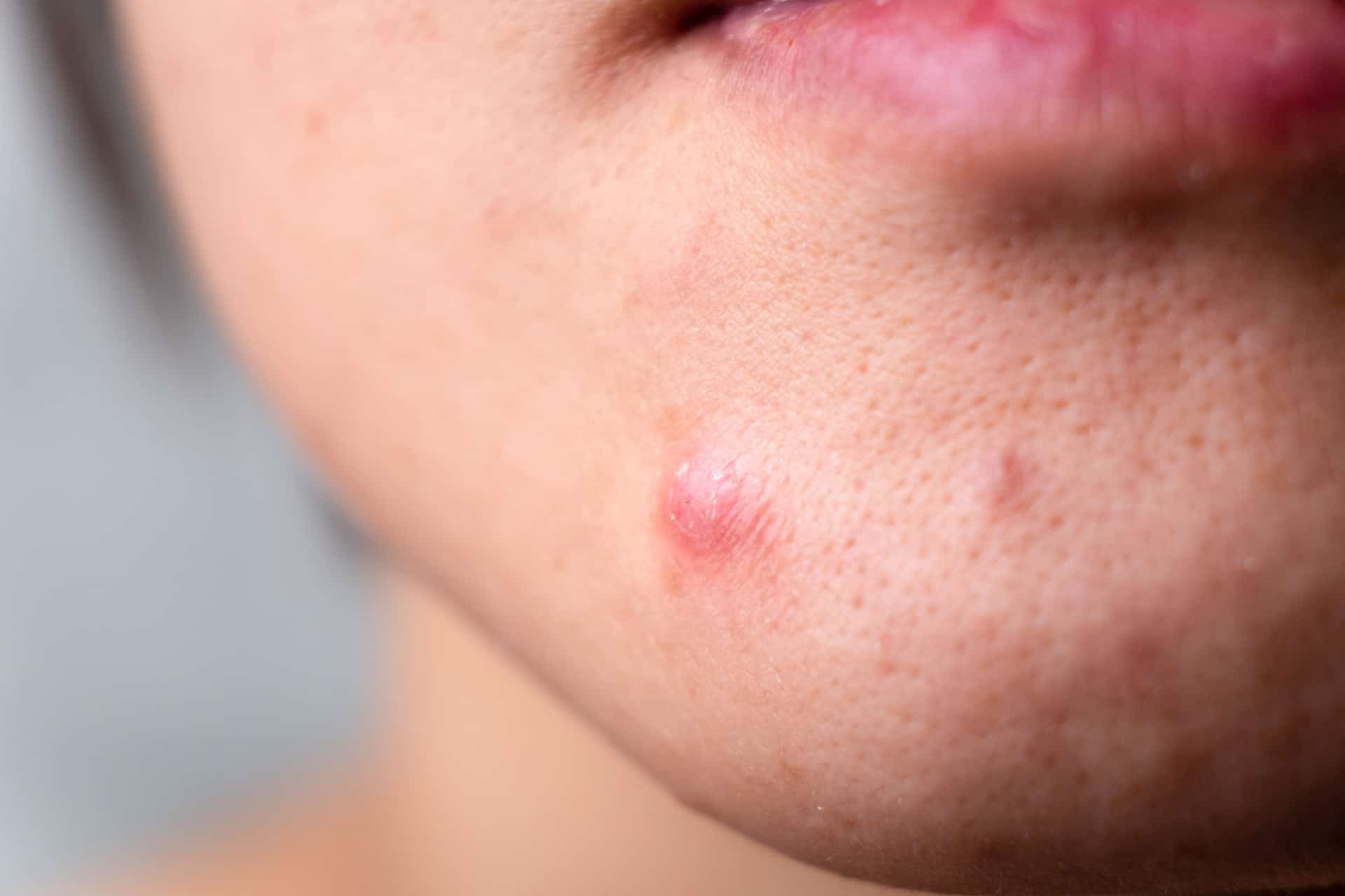 Le cicatrici acneiche: cosa sono e come curarle