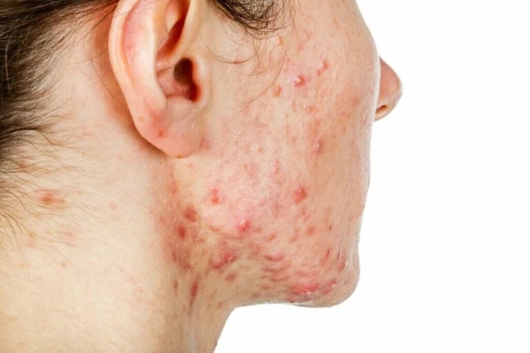 Dermatologia: parliamo di acne cistica