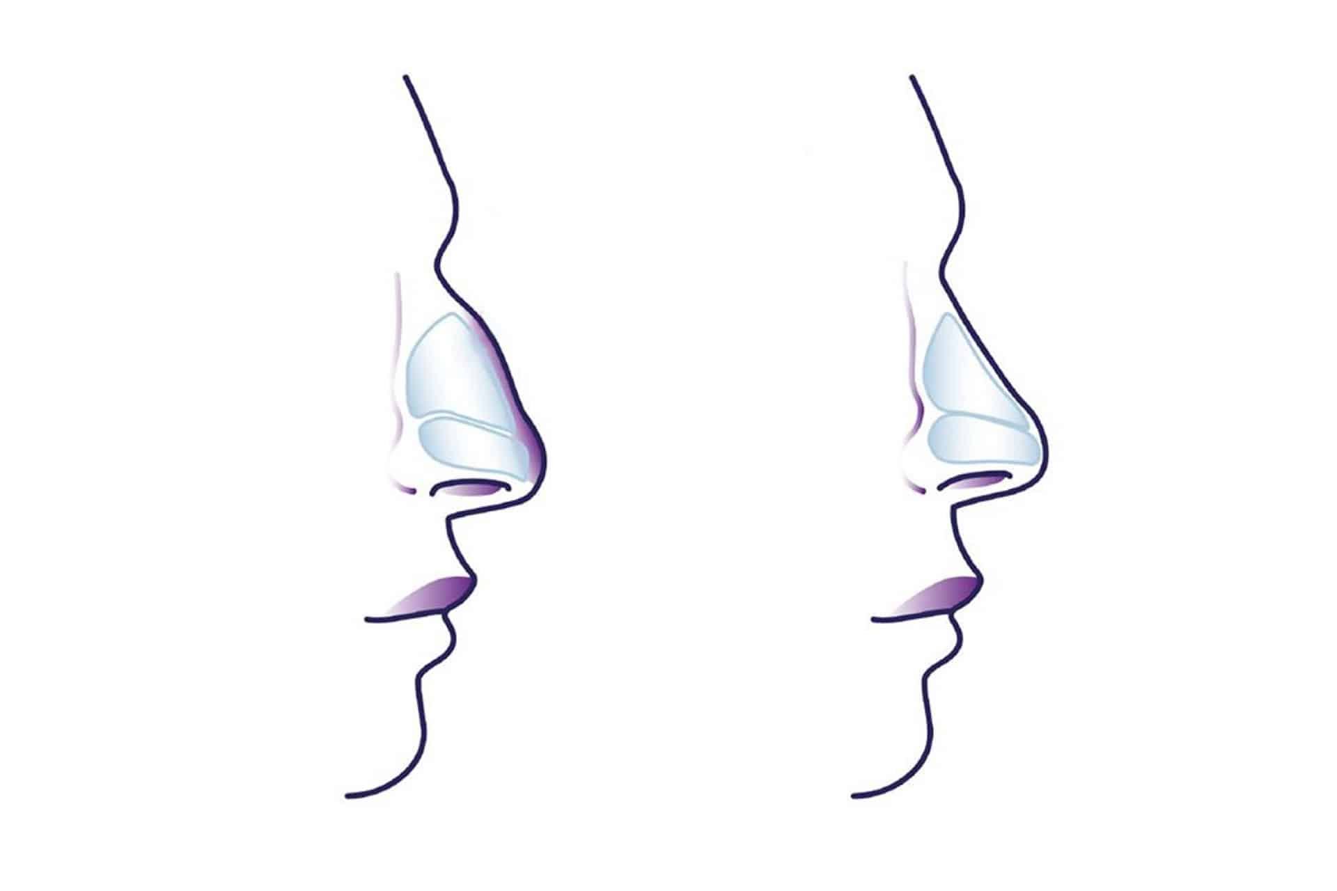 Rinoplastica, la chirurgia estetica per il naso: quello che c’è da sapere