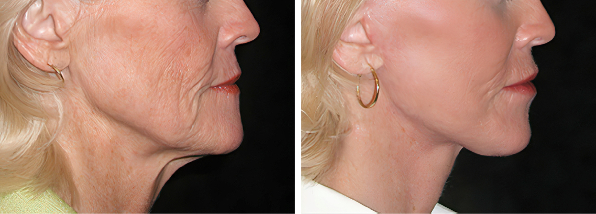 METODO INTEGRA: Thermage viso per trattare la lassità della pelle del viso.