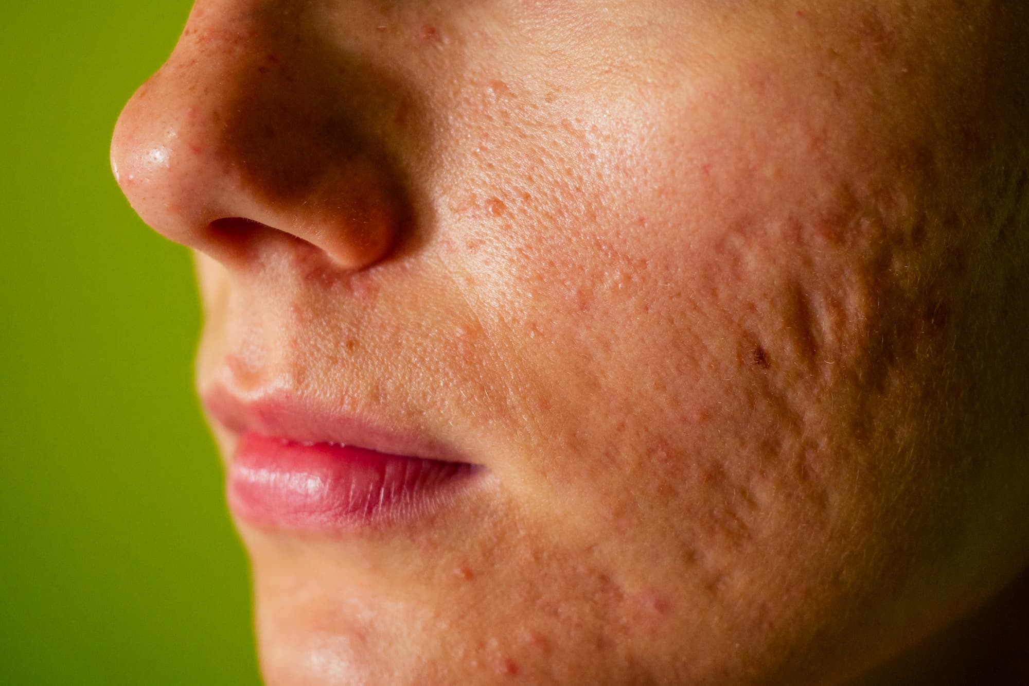 Cura dell’acne e delle sue cicatrici